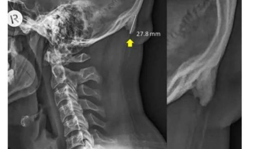 Ученые выяснили, что из-за смартфонов у людей начинают расти рога